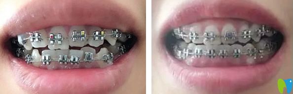 深圳瑞爾齒科牙齒矯正效果對(duì)比圖
