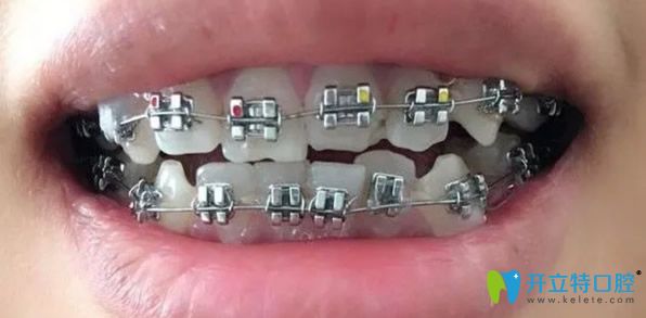 金屬托槽矯正牙齒價(jià)格比較實(shí)惠