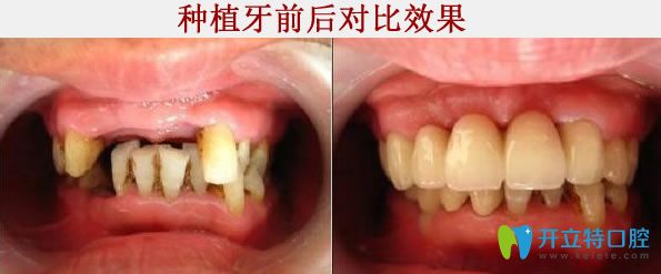 <!--<i data=20240703-sp></i>-->牙科種植牙前后對比照