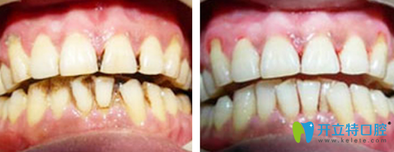 深圳諾得口腔張榮水牙周病治療前后對比圖