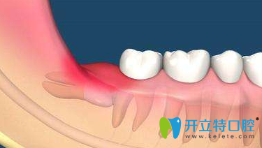 智齒牙齦腫痛怎么辦？分享牙齦快速消腫止痛小妙招