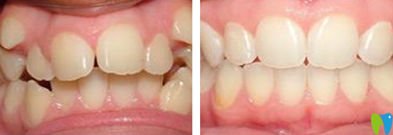 深圳諾德齒科時代天使隱形矯正案例