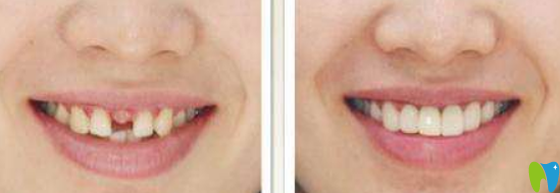 深圳諾德口腔單顆牙缺失治療前后照片