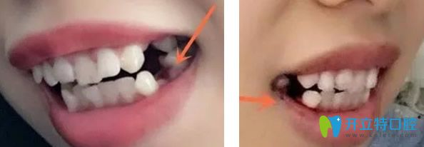 牙齒太擁擠矯正前拔掉四顆牙齒