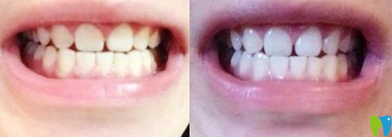 諾德口腔潔牙前后對比照片效果展示