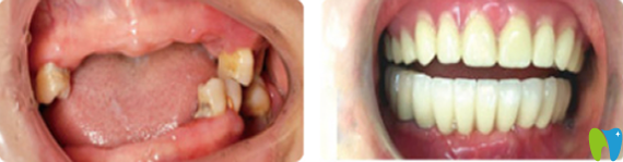 諾德齒科半口牙缺失種植案例