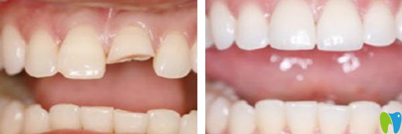 深圳諾德齒科牙齒修復前后對比照片