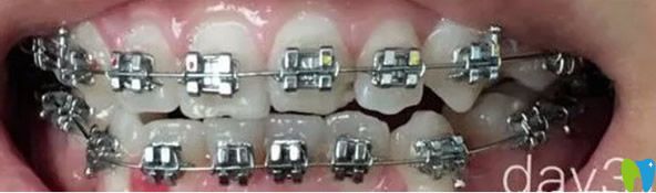 深圳瑞爾齒科牙齒矯正一個(gè)月效果