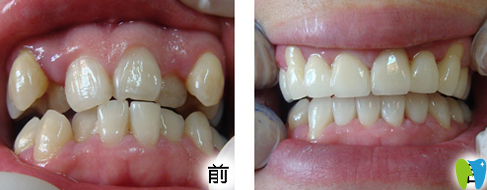 穗江口腔隱形牙齒矯正前后效果對(duì)比圖