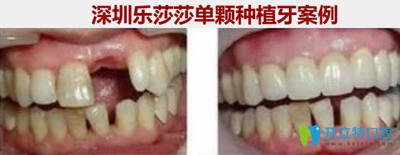 <!--<i data=20240703-sp></i>-->申方洪即刻種植牙前后對(duì)比圖