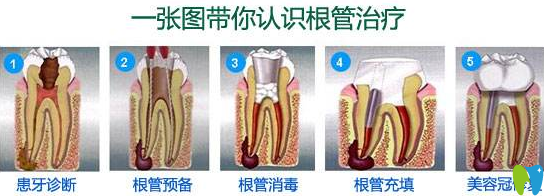 廣州穗江口腔醫(yī)生揭秘顯微根管治療費(fèi)用及治療步驟