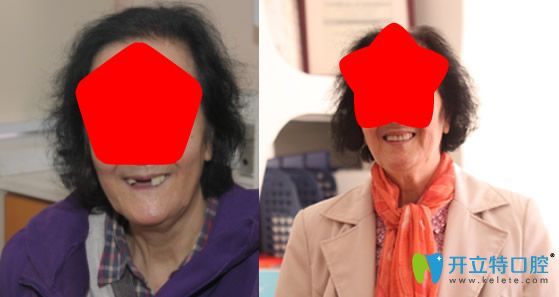 張煒院長為門牙缺失的患者種植牙案例 張煒院長為門牙缺失的患者種植牙案例