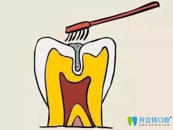 孩子幾歲做窩溝封閉合適？做完窩溝封閉后還會長蛀牙嗎？