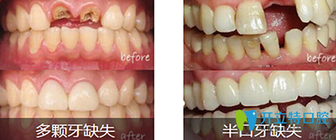 汪洋齒科吳健雄種植牙案例