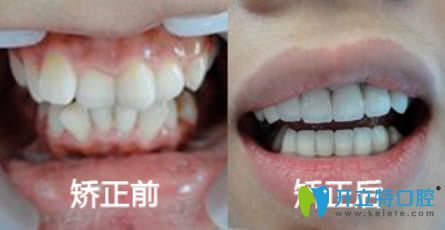 隱適美隱形矯正前后對比效果