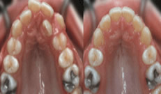 牙齒擁擠不齊如何矯正?深圳宏山齒科牙齒矯正真人案例演示