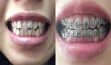 齙牙怎么矯正?在深圳汪洋齒科做牙齒正畸4個(gè)月就能去牙套啦