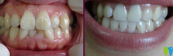 深圳歡樂口腔牙齒矯正效果對比圖