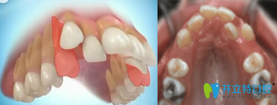 深著呢宏山齒科牙齒矯正拔牙過程圖