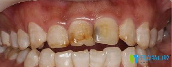 深圳博愛(ài)口腔皓齒美白前的照片