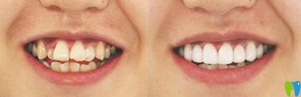 博愛(ài)口腔牙齒矯正前后效果