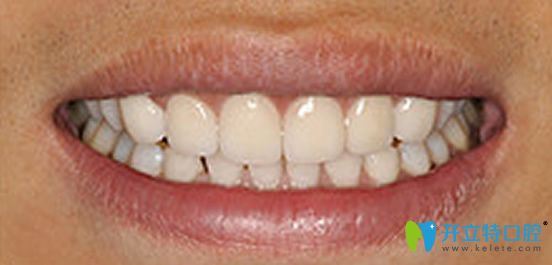 博愛(ài)口腔皓齒美白后的照片