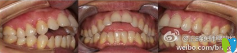 深圳蒙恩齒科程碧煥成人開合隱適美矯正效果圖