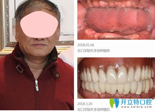 張宏山院長采用功夫種植技術(shù)種植牙案例