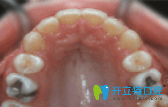 宏山齒科牙齒矯正后圖片