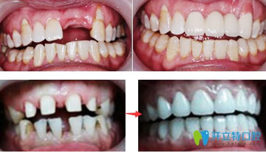 詹華院長(zhǎng)種植牙+牙齒矯正修復(fù)效果案例