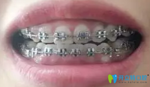 在深圳汪洋齒科做牙齒正畸第95天照片展示 在深圳汪洋齒科做牙齒正畸第95天照片展示
