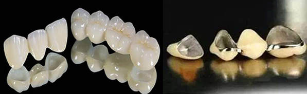 ?深圳博愛口腔解析 為什么全瓷牙價格比烤瓷牙高 區(qū)別在哪