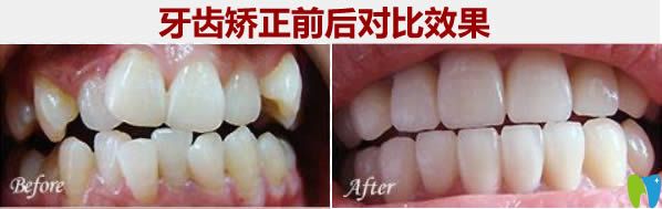 28歲顧客時(shí)代天使矯正前后對比照