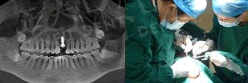 深圳正夫口腔種植牙過程圖