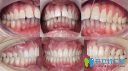 杭州牙科矯正牙齒效果 杭州牙科矯正牙齒效果