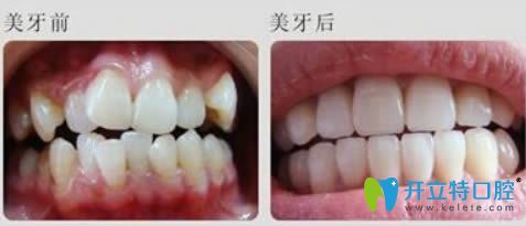 廣州華美李醫(yī)生隱適美矯正前后對(duì)比效果】