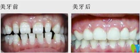 廣州華美口腔李敏華牙齒稀疏矯正前對(duì)比圖