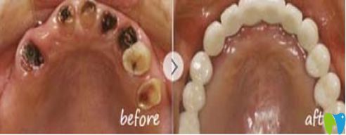 廣州雅皓口腔門診部牙殘根修復(fù)對比圖