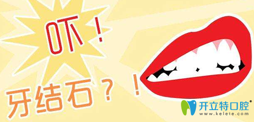 牙結石除了洗牙能去掉還有八大清除牙結石小竅門可參考喲