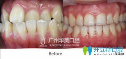 廣州華美數(shù)字化隱形正畸對比案例