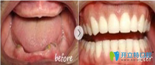 廣州雅皓齒科全口牙缺失修復(fù)對比圖