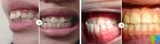牙博士口腔牙齒矯正案例對(duì)比圖