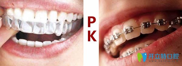 牙齒矯正中的牙箍和牙套有什么區(qū)別？通過比較來看哪個(gè)好