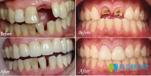 佛山中大口腔曾榮華門牙缺失種植牙前后對比效果