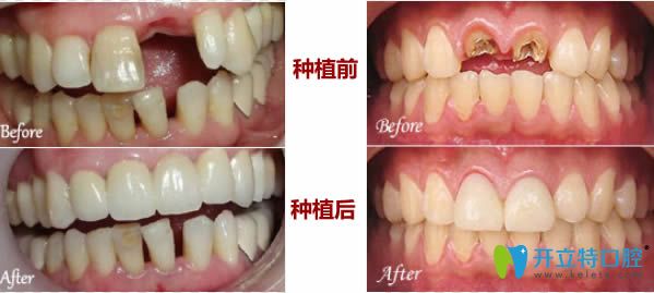 佛山中大口腔門牙缺失種植前后對(duì)比圖