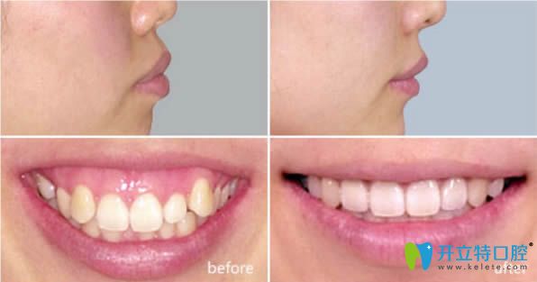 28歲凸嘴牙齒矯正前后對比照
