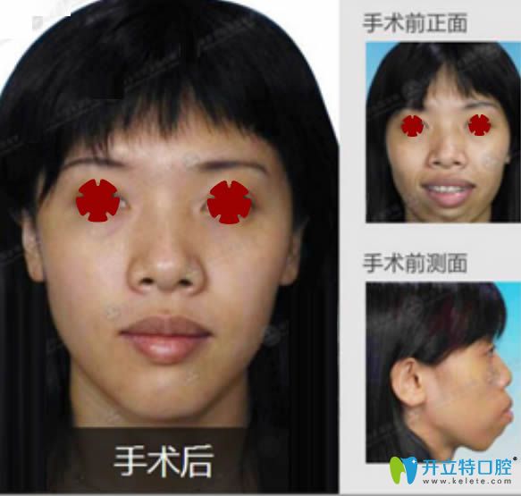 薛國初齙牙正頜手術(shù)前后對(duì)比案例