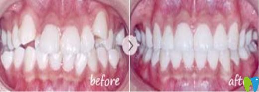 廣州雅皓牙科牙齒正畸對比圖