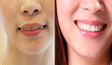 你信嗎?齙牙妹子在蘇州牙博士口腔僅花費(fèi)7天就完成牙齒正畸