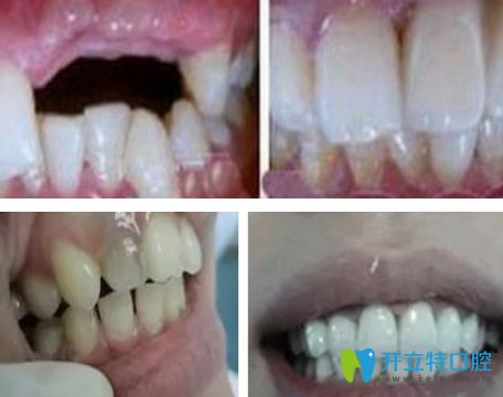 廣州瑞德口腔王玉棟醫(yī)生種植牙+全瓷貼面修復(fù)效果對比圖